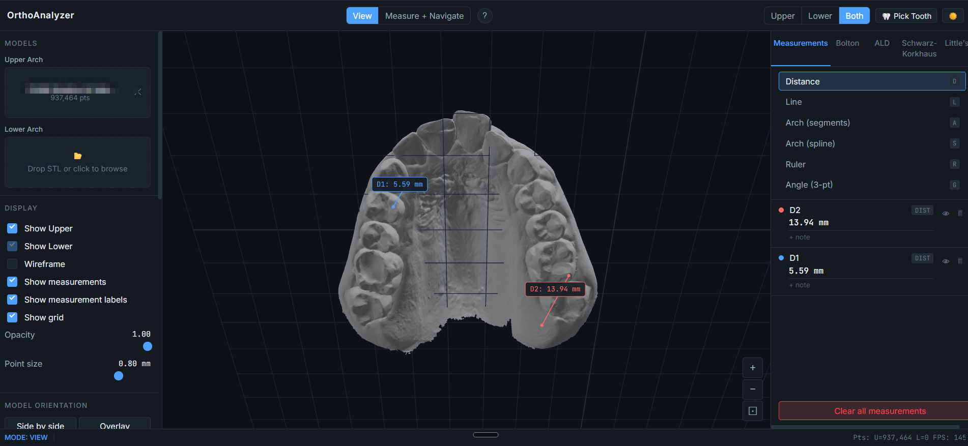 OrthoAnalyzer 3D viewport showing an upper-arch dental model with two distance measurements (patient identifier anonymized)